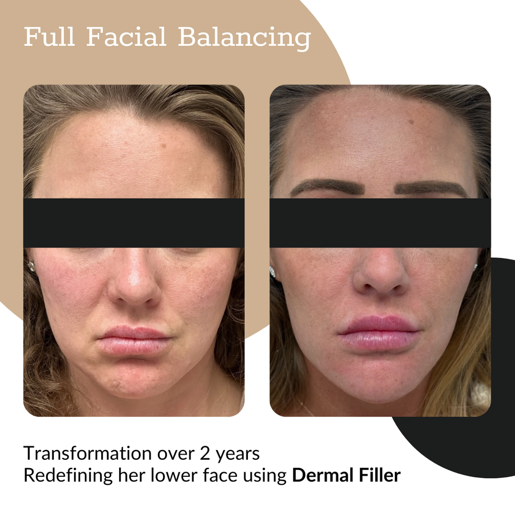 3-Syringe Dermal Filler Package
