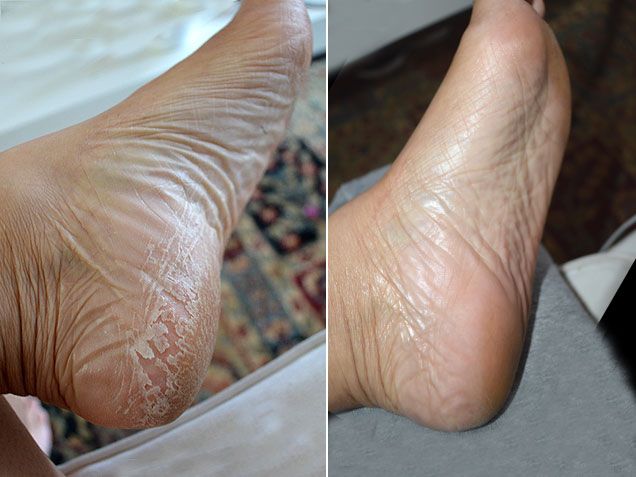 Original Exfoliation Foot Peel