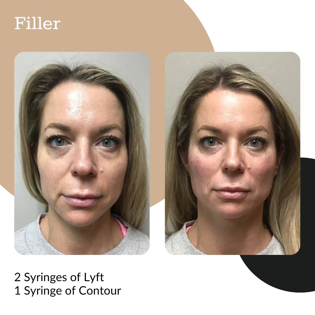 3-Syringe Dermal Filler Package