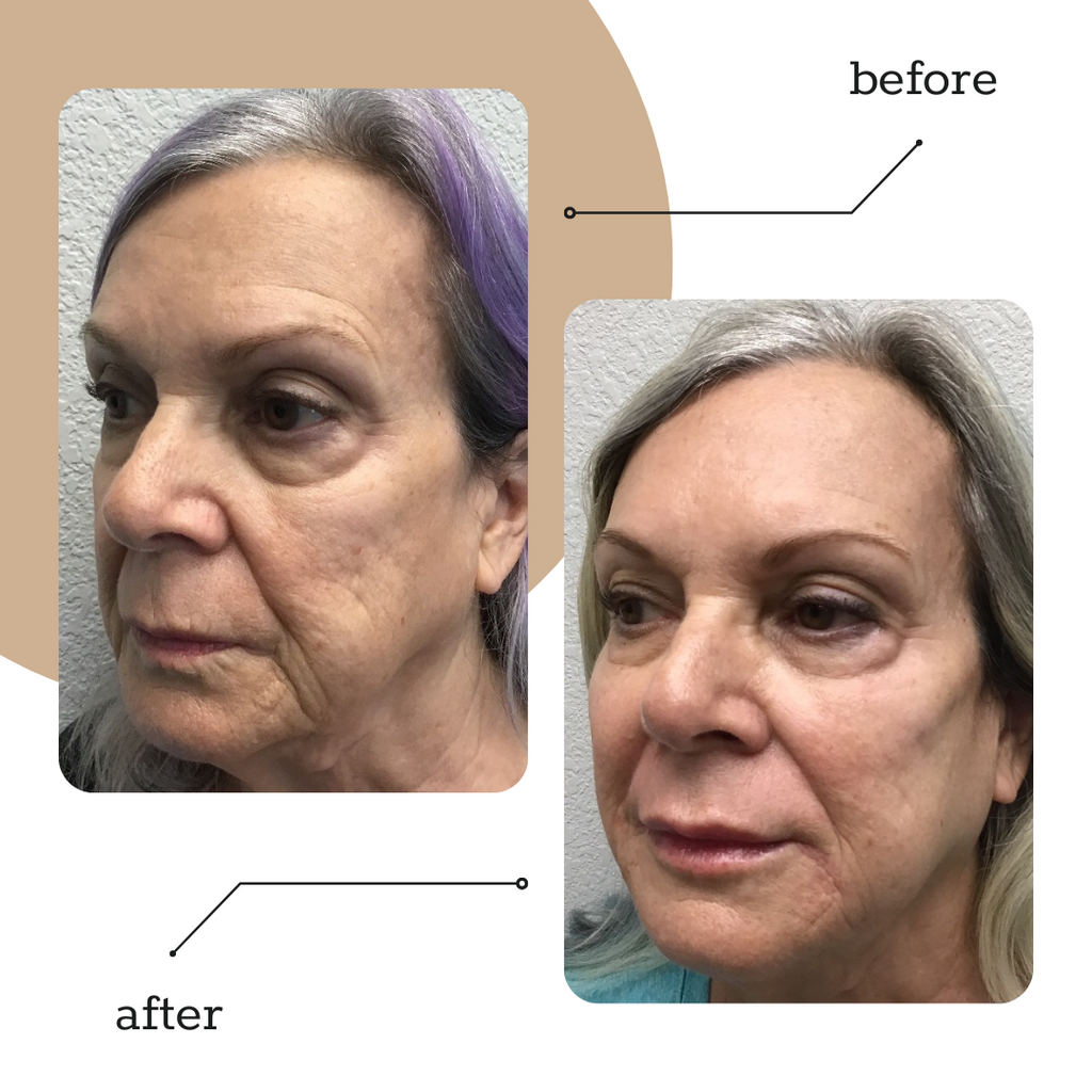 3-Syringe Dermal Filler Package