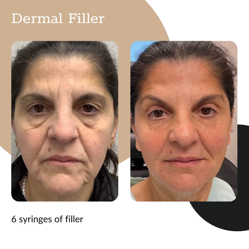 3-Syringe Dermal Filler Package