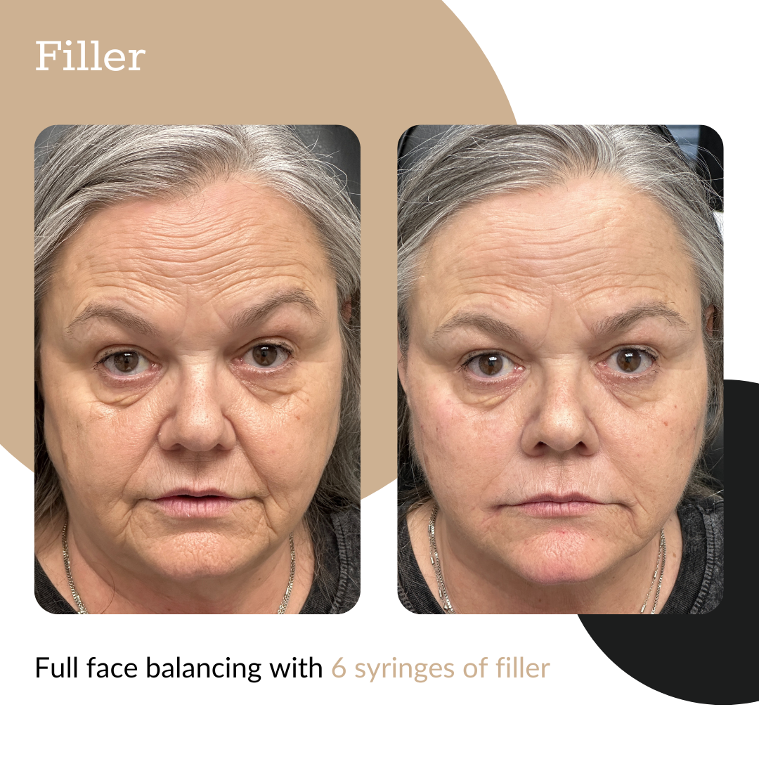 3-Syringe Dermal Filler Package