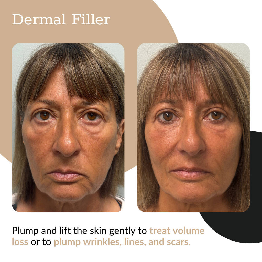 3-Syringe Dermal Filler Package