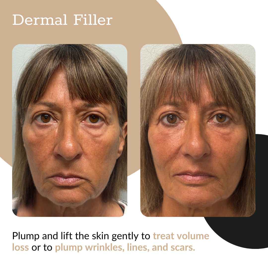 3-Syringe Dermal Filler Package