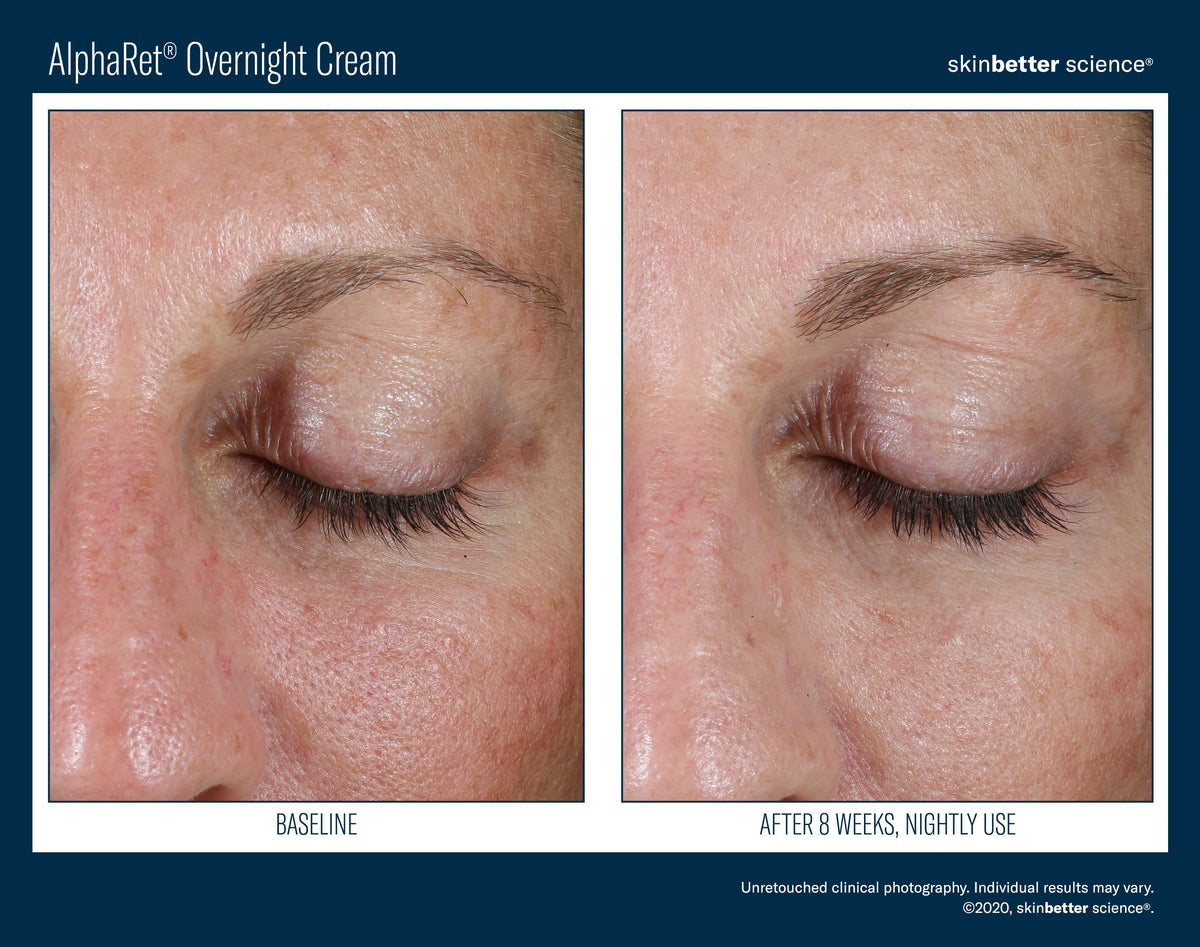 AlphaRet Overnight Cream