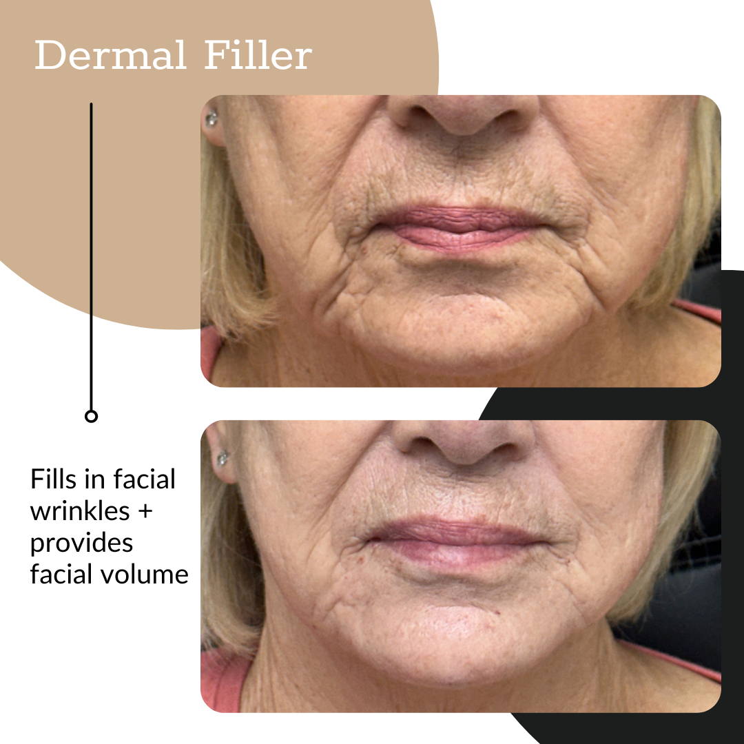 3-Syringe Dermal Filler Package