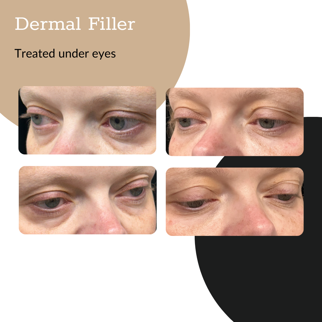 3-Syringe Dermal Filler Package