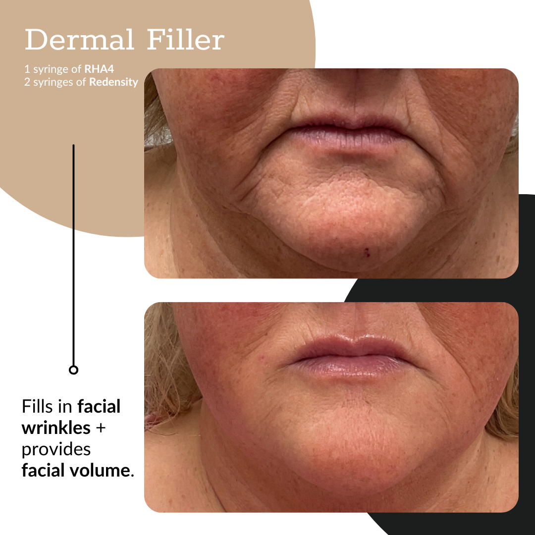 3-Syringe Dermal Filler Package