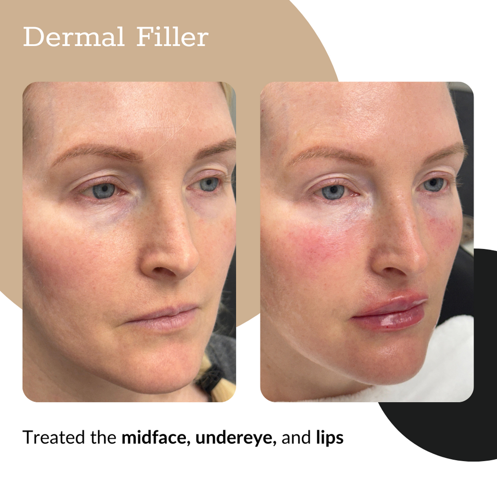 3-Syringe Dermal Filler Package