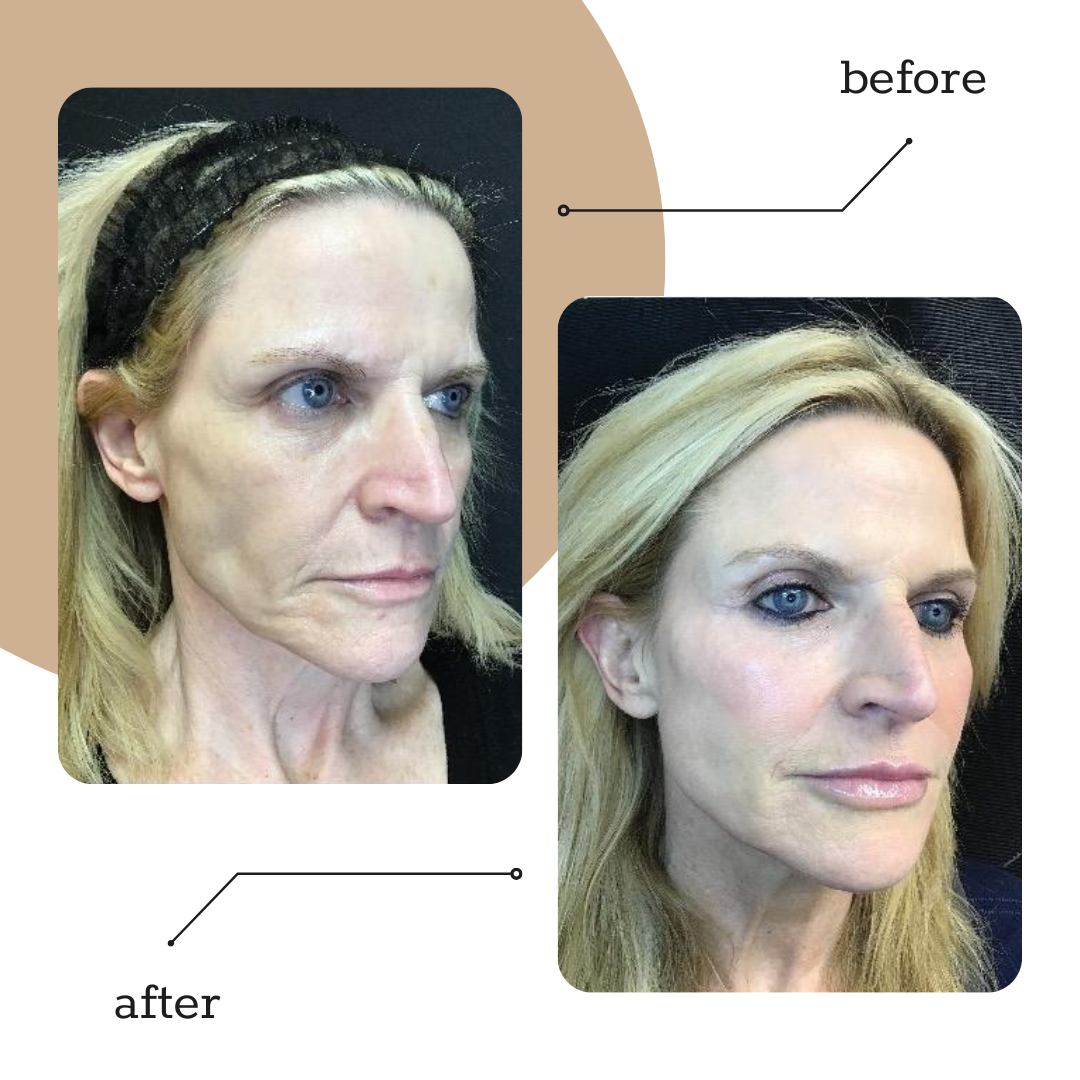3-Syringe Dermal Filler Package