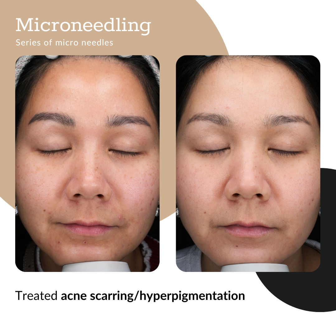 Summer Microneedling Package