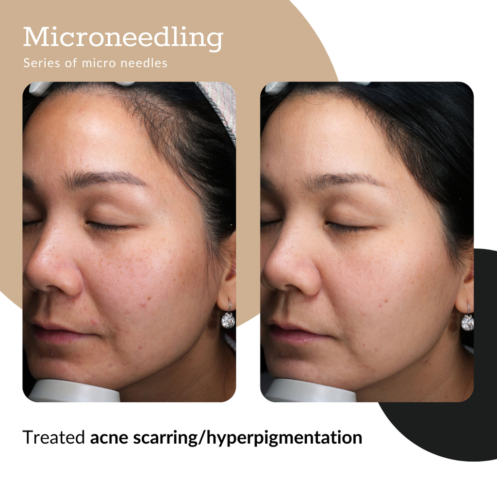Summer Microneedling Package