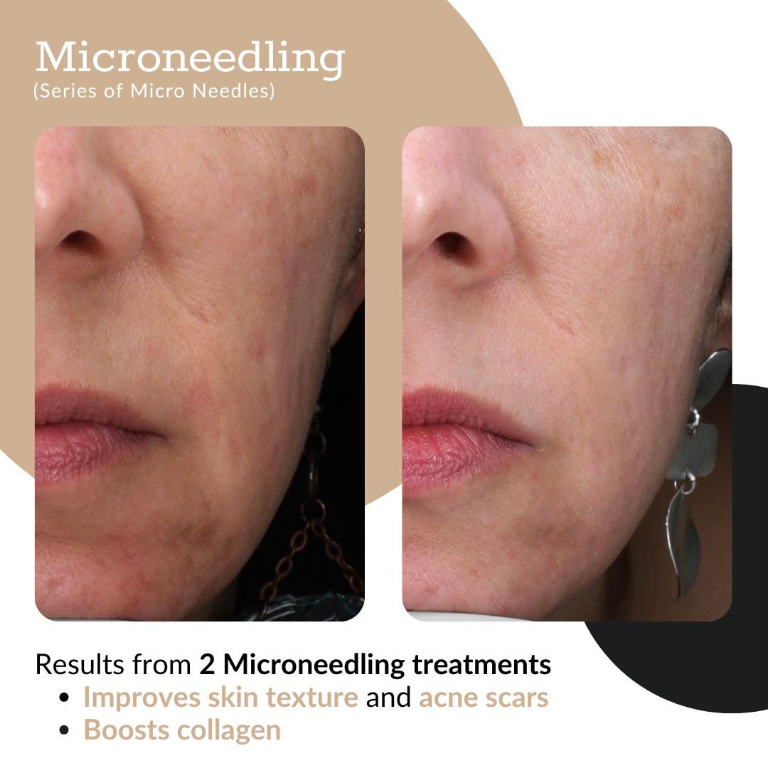 Summer Microneedling Package