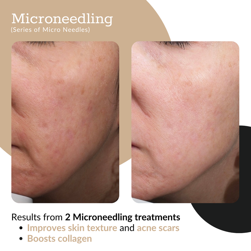 Summer Microneedling Package