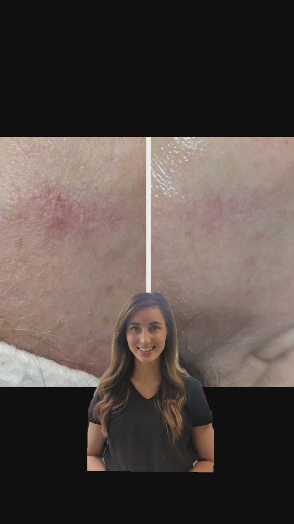 Summer Microneedling Package